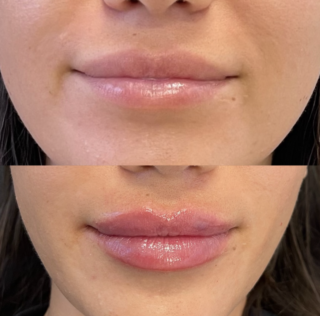 lip fillers downers grove